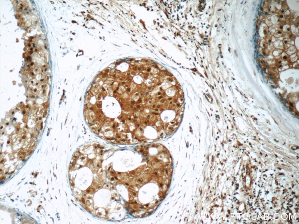 Immunohistochemistry (IHC) staining of human breast cancer tissue using SNAPC5 Polyclonal antibody (17272-1-AP)