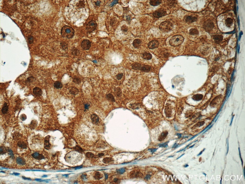 Immunohistochemistry (IHC) staining of human breast cancer tissue using SNAPC5 Polyclonal antibody (17272-1-AP)