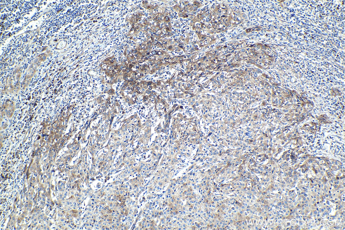 Immunohistochemistry (IHC) staining of human cervical cancer tissue using SNAT2 Polyclonal antibody (25928-1-AP)