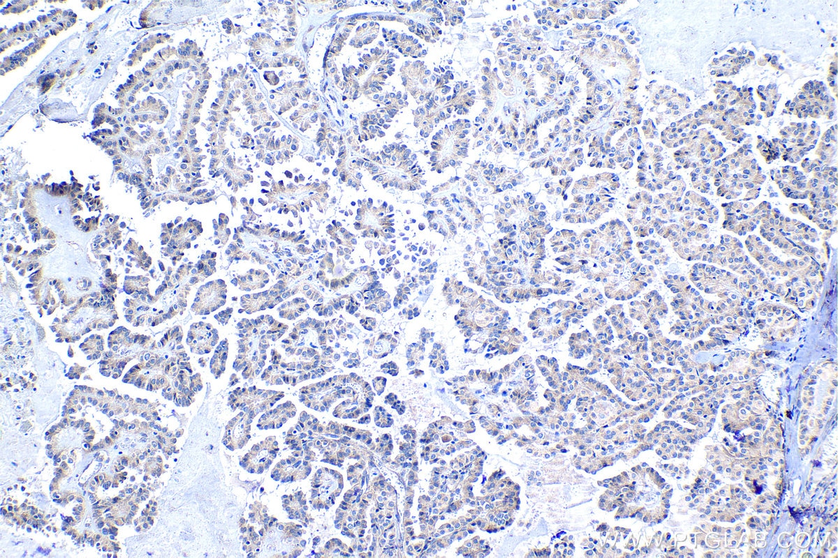 Immunohistochemistry (IHC) staining of human thyroid cancer tissue using SNAT2 Polyclonal antibody (25928-1-AP)