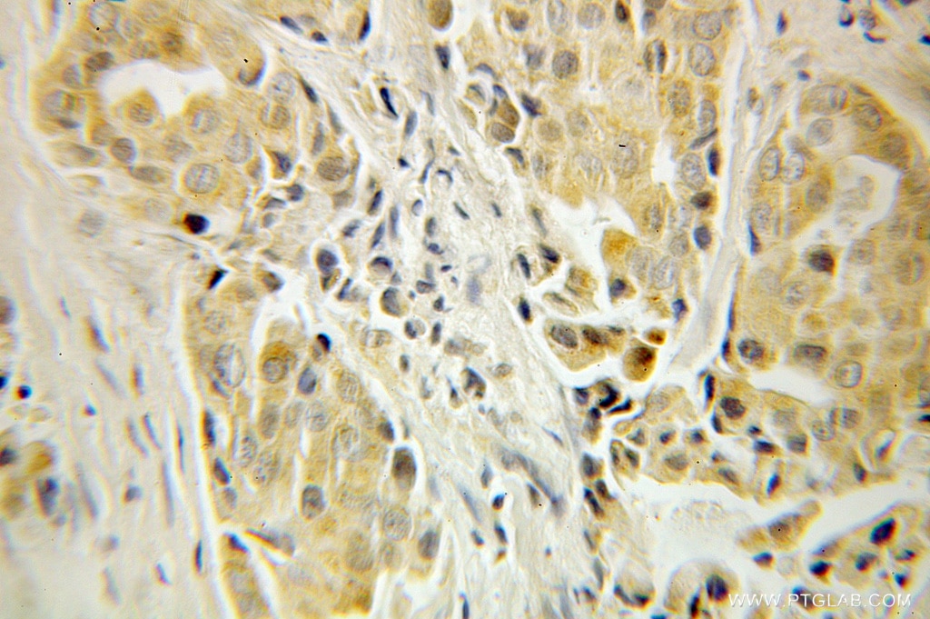 Immunohistochemistry (IHC) staining of human breast cancer tissue using SNCB Polyclonal antibody (10498-1-AP)