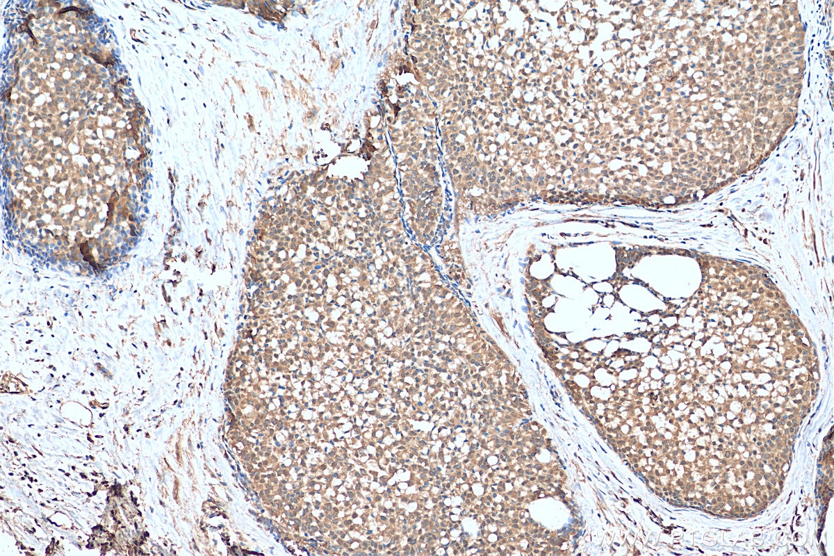 Immunohistochemistry (IHC) staining of human breast hyperplasia tissue using SND1 Polyclonal antibody (10760-1-AP)