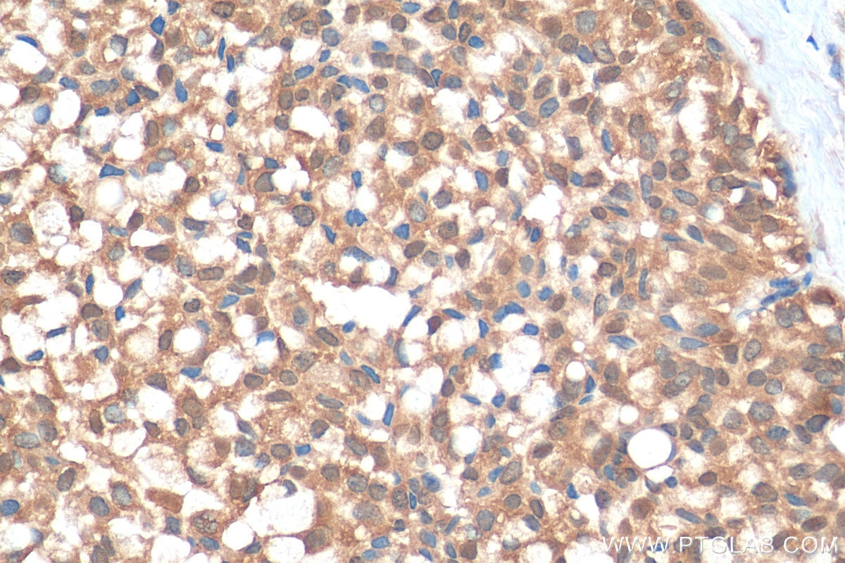 Immunohistochemistry (IHC) staining of human breast hyperplasia tissue using SND1 Polyclonal antibody (10760-1-AP)