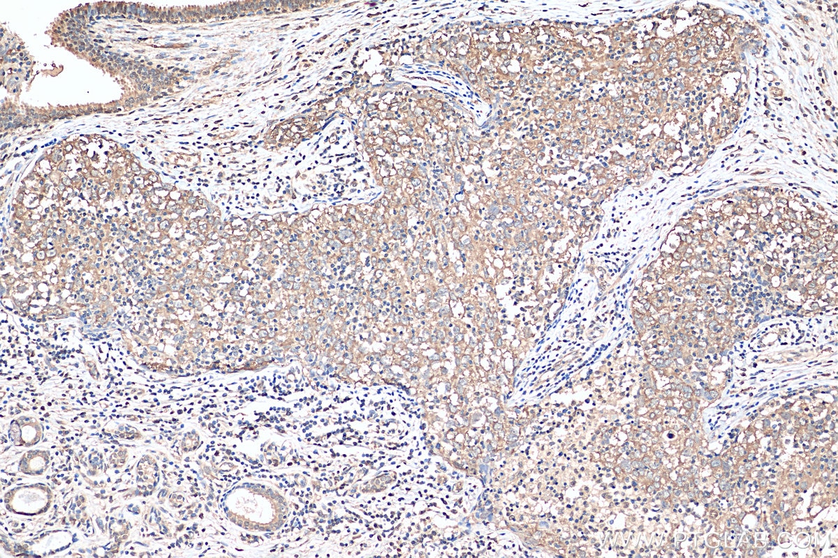 IHC staining of human breast cancer using 10760-1-AP