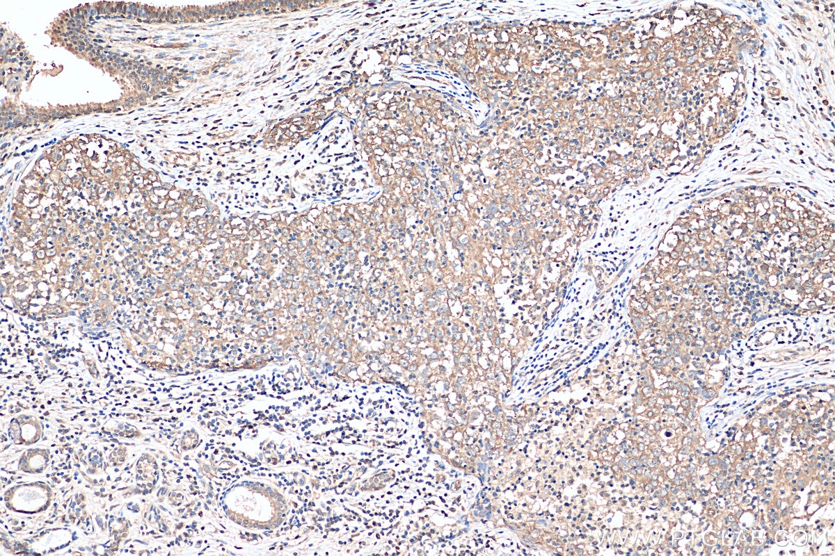 Immunohistochemistry (IHC) staining of human breast cancer tissue using SND1 Polyclonal antibody (10760-1-AP)