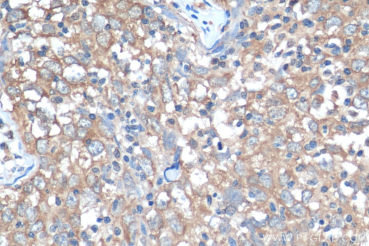 Immunohistochemistry (IHC) staining of human breast cancer tissue using SND1 Polyclonal antibody (10760-1-AP)