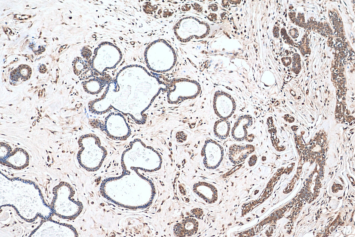 Immunohistochemistry (IHC) staining of human breast cancer tissue using SND1 Polyclonal antibody (10760-1-AP)