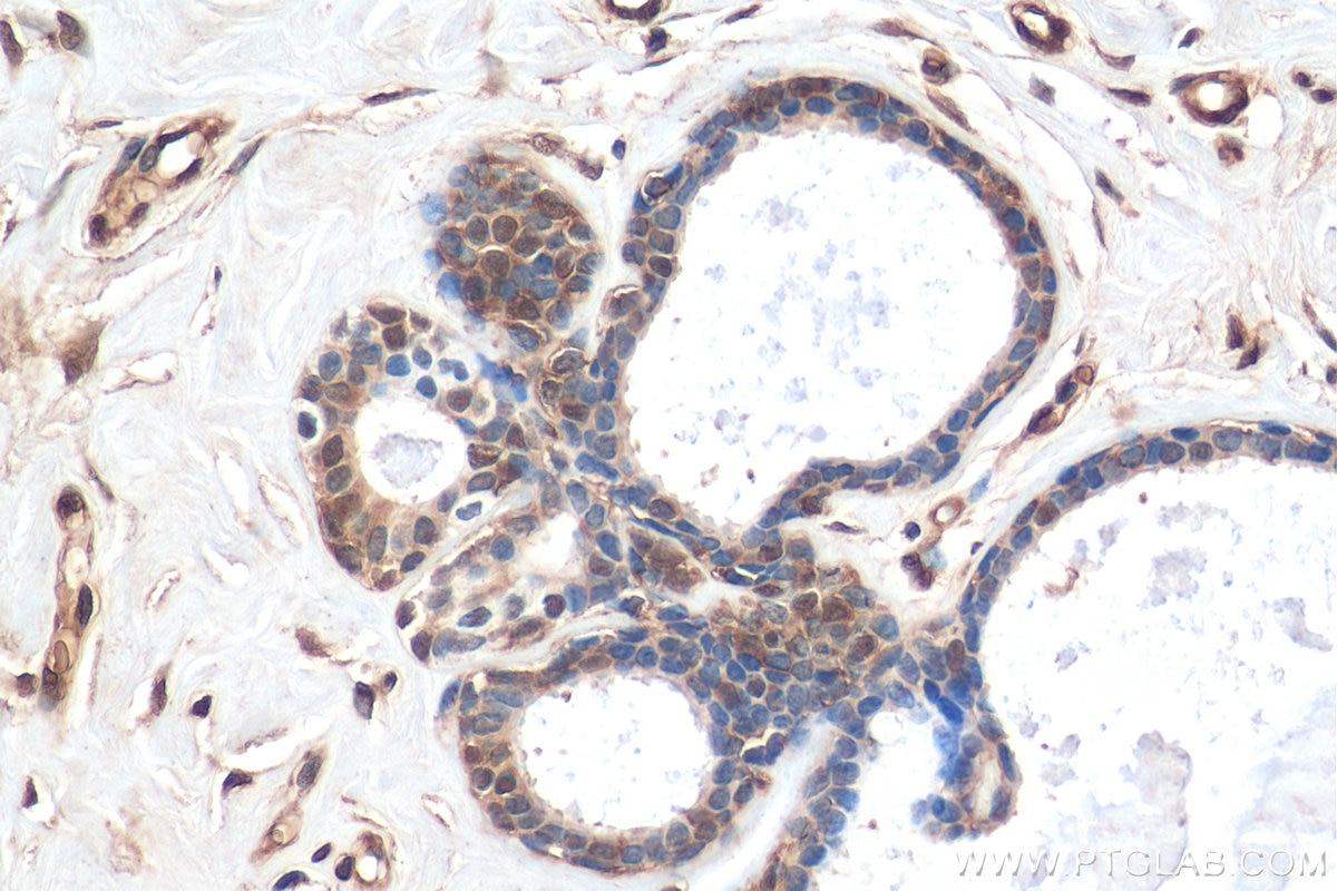 IHC staining of human breast cancer using 10760-1-AP