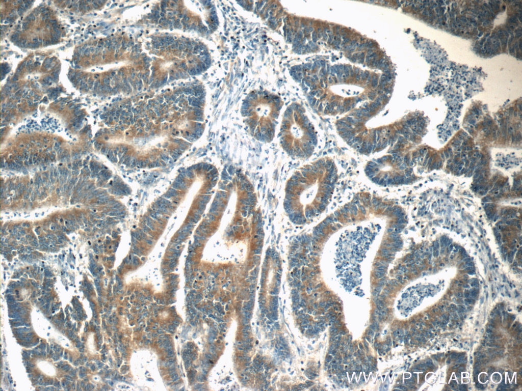 Immunohistochemistry (IHC) staining of human colon cancer tissue using SND1 Monoclonal antibody (60265-1-Ig)