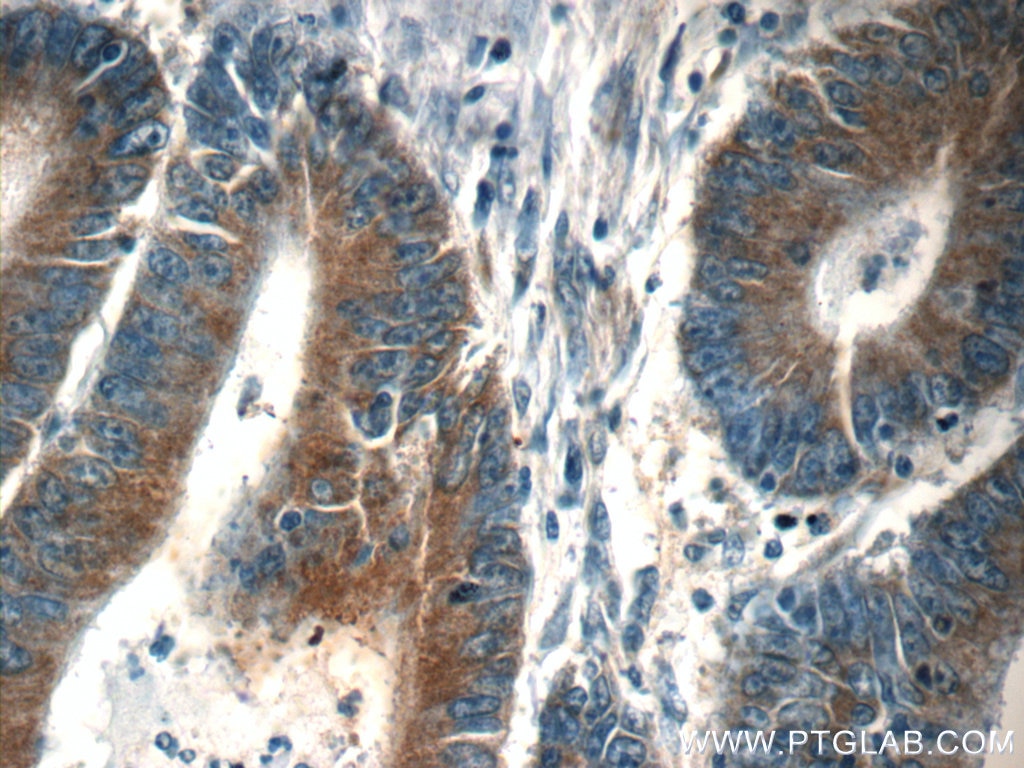 Immunohistochemistry (IHC) staining of human colon cancer tissue using SND1 Monoclonal antibody (60265-1-Ig)