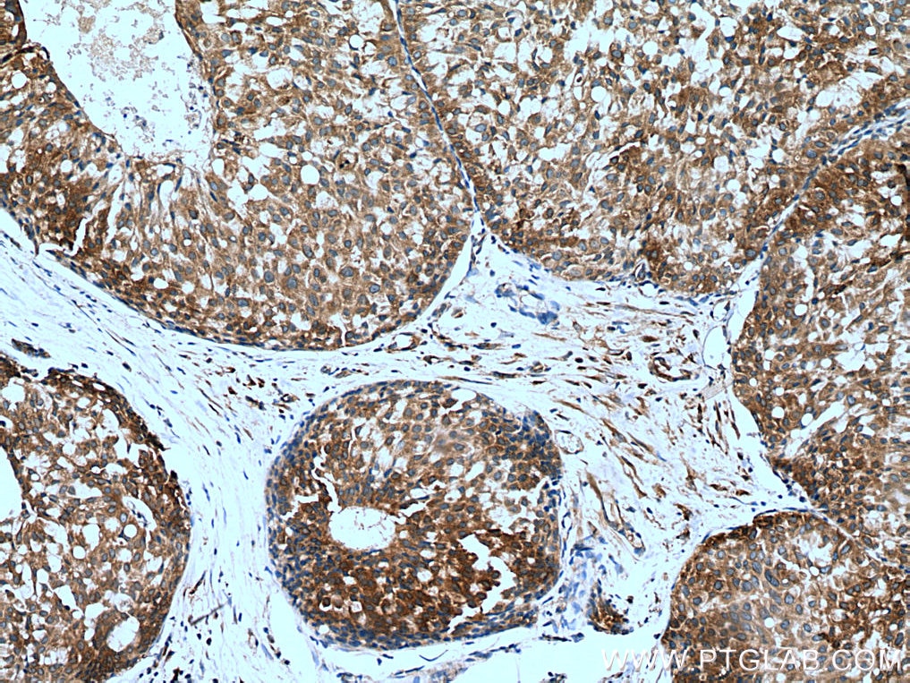 Immunohistochemistry (IHC) staining of human breast hyperplasia tissue using SND1 Monoclonal antibody (60265-1-Ig)