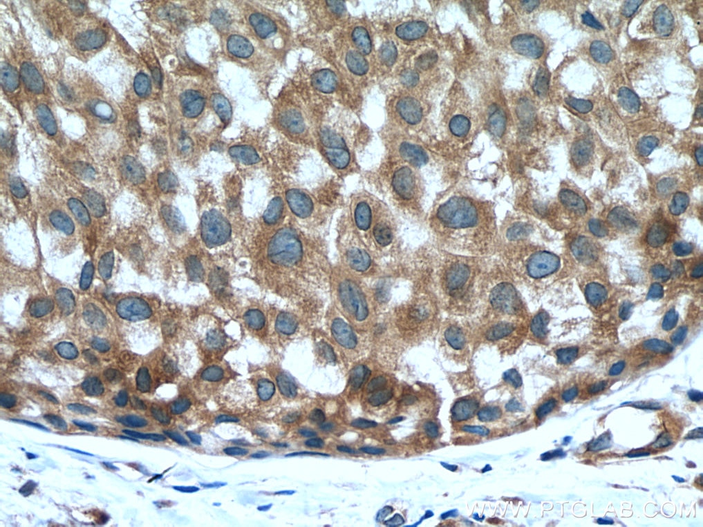 Immunohistochemistry (IHC) staining of human breast hyperplasia tissue using SND1 Monoclonal antibody (60265-1-Ig)