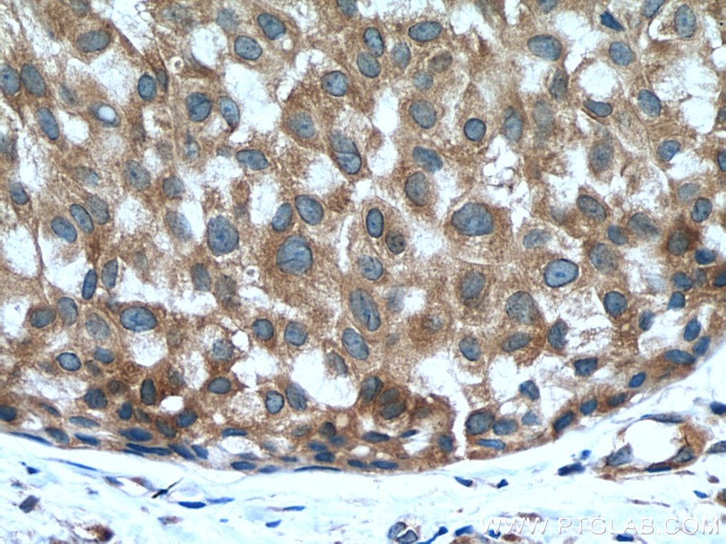 IHC staining of human breast hyperplasia using 60265-1-Ig