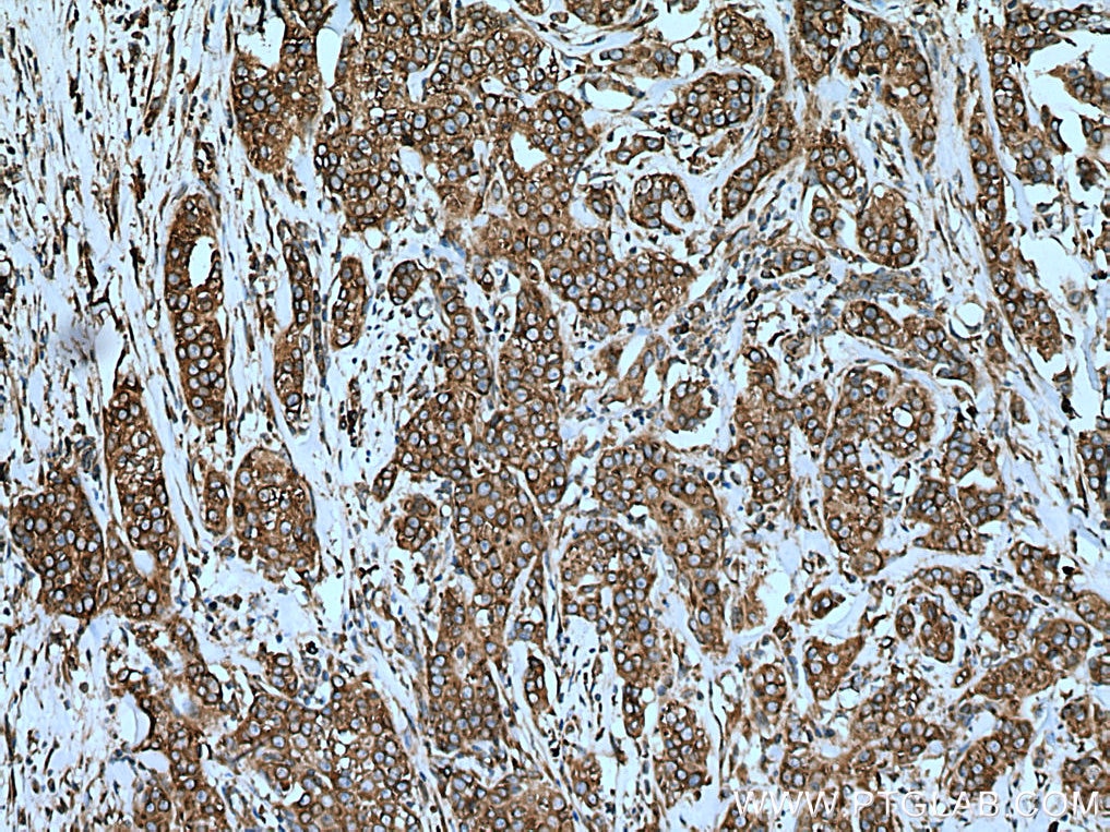 IHC staining of human breast cancer using 60265-1-Ig