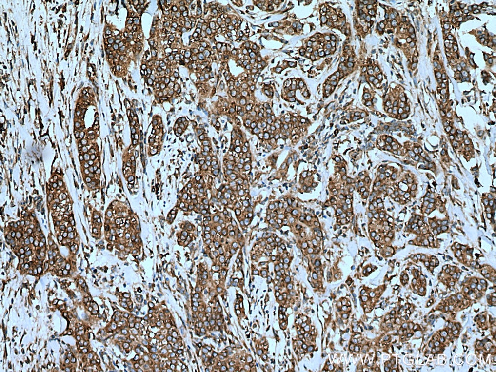 Immunohistochemistry (IHC) staining of human breast cancer tissue using SND1 Monoclonal antibody (60265-1-Ig)