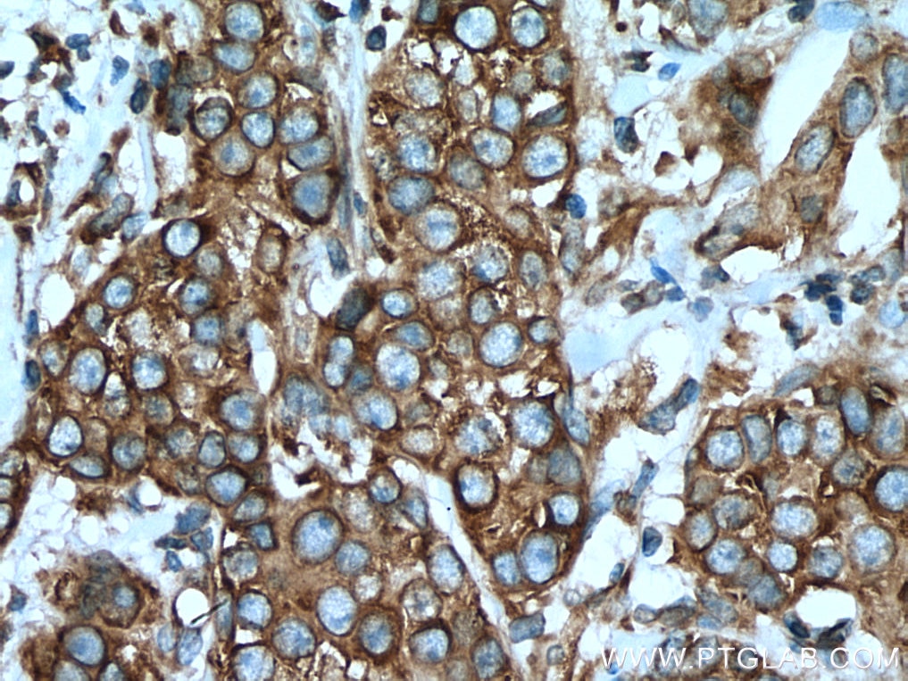 Immunohistochemistry (IHC) staining of human breast cancer tissue using SND1 Monoclonal antibody (60265-1-Ig)