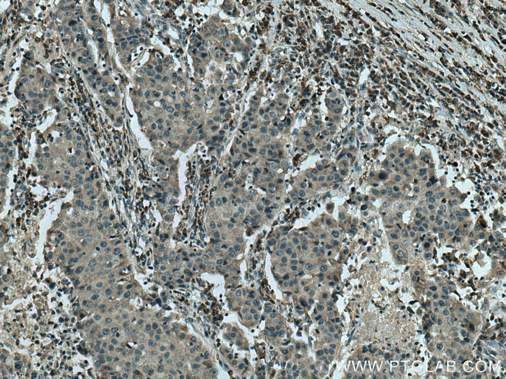 Immunohistochemistry (IHC) staining of human breast cancer tissue using SNF8 Monoclonal antibody (67696-1-Ig)