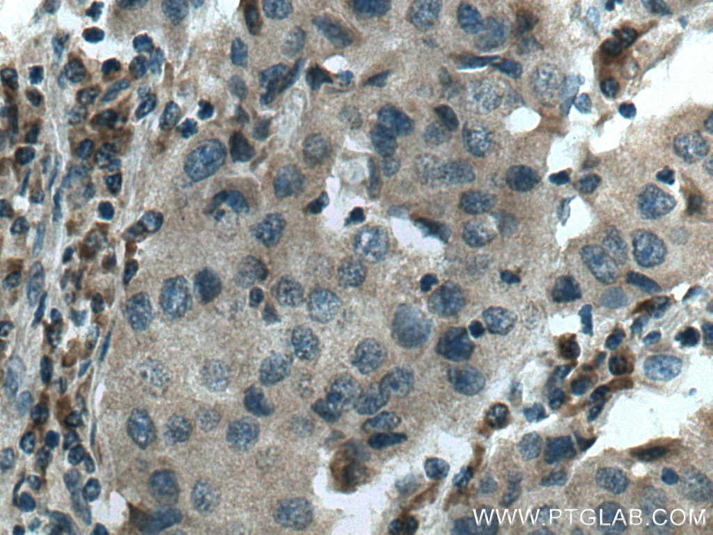 Immunohistochemistry (IHC) staining of human breast cancer tissue using SNF8 Monoclonal antibody (67696-1-Ig)
