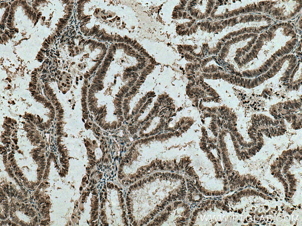 Immunohistochemistry (IHC) staining of human ovary tumor tissue using RCC1 Polyclonal antibody (10697-1-AP)