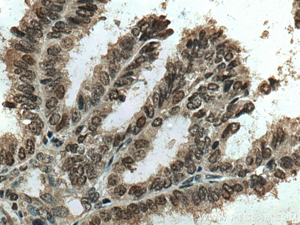 Immunohistochemistry (IHC) staining of human ovary tumor tissue using RCC1 Polyclonal antibody (10697-1-AP)