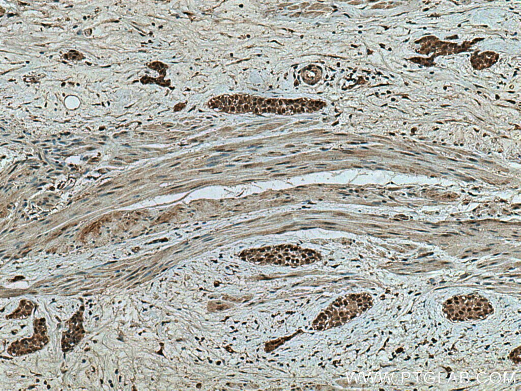 IHC staining of human urothelial carcinoma using 10697-1-AP