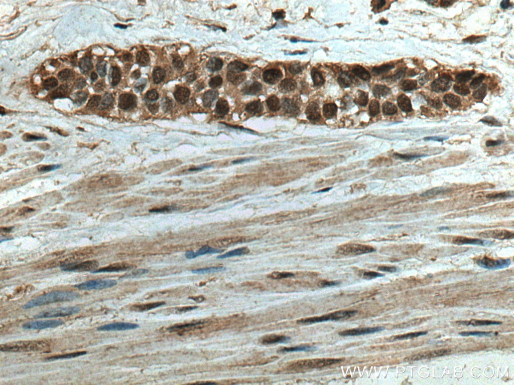 Immunohistochemistry (IHC) staining of human urothelial carcinoma tissue using RCC1 Polyclonal antibody (10697-1-AP)