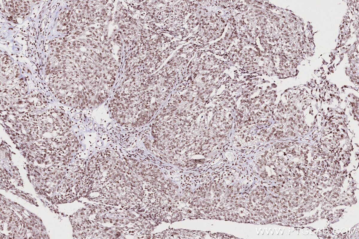 IHC staining of human ovary cancer using 82962-1-RR Immunohistochemistry (IHC) staining of human ovary cancer tissue using SNIP1 Recombinant monoclonal antibody (82962-1-RR)