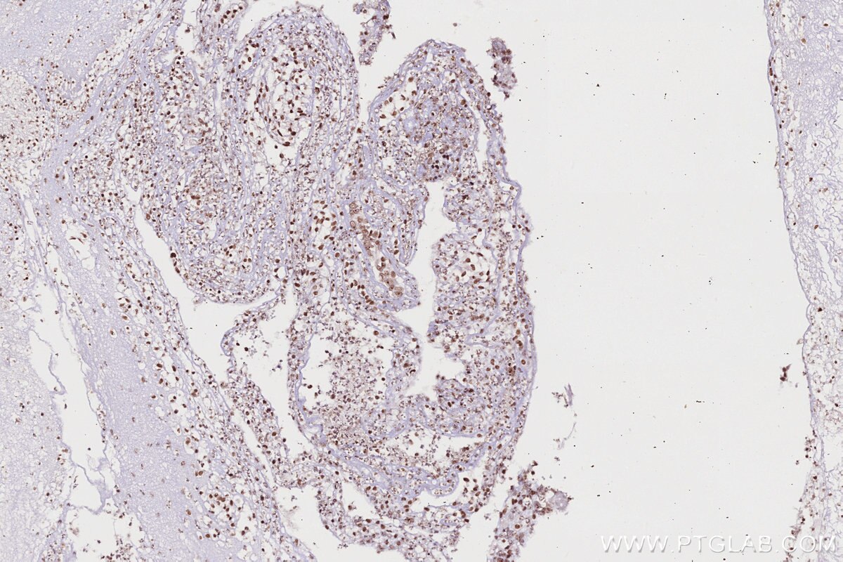 IHC staining of human ovary cancer using 82962-1-RR Immunohistochemistry (IHC) staining of human ovary cancer tissue using SNIP1 Recombinant monoclonal antibody (82962-1-RR)