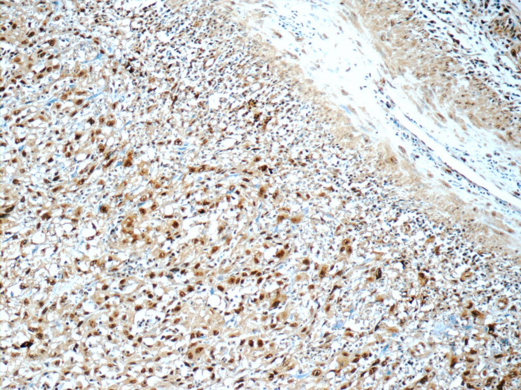 Immunohistochemistry (IHC) staining of human cervical cancer tissue using SNRPA Polyclonal antibody (10212-1-AP)