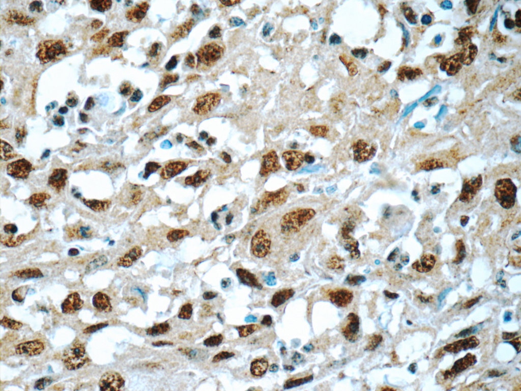 Immunohistochemistry (IHC) staining of human cervical cancer tissue using SNRPA Polyclonal antibody (10212-1-AP)