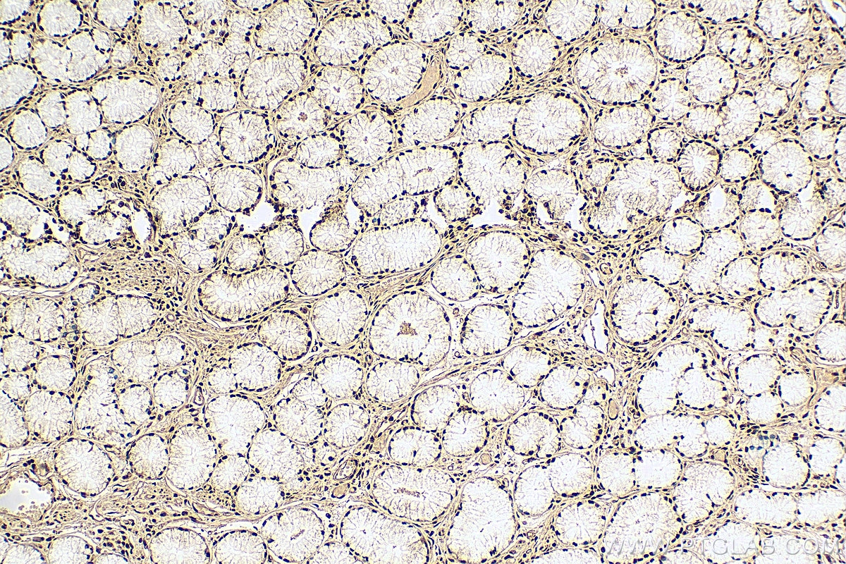 Immunohistochemistry (IHC) staining of human stomach cancer tissue using SNRPA Polyclonal antibody (10212-1-AP)