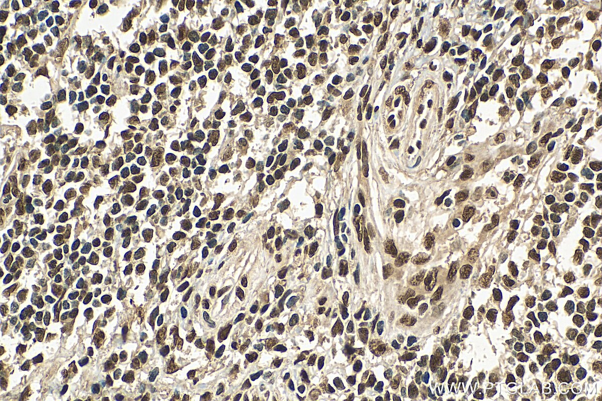 Immunohistochemistry (IHC) staining of human stomach cancer tissue using SNRPA Polyclonal antibody (10212-1-AP)