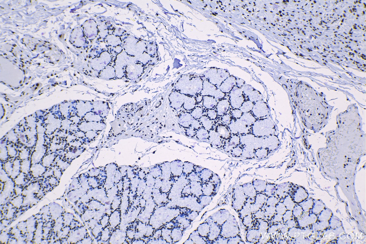 Immunohistochemistry (IHC) staining of human stomach cancer tissue using SNRPA1 Polyclonal antibody (17368-1-AP)