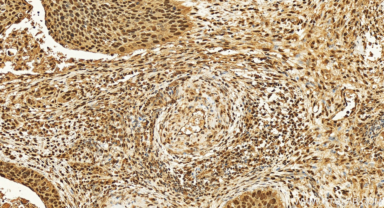 Immunohistochemistry (IHC) staining of human cervical cancer tissue using SNRPB Polyclonal antibody (16807-1-AP)