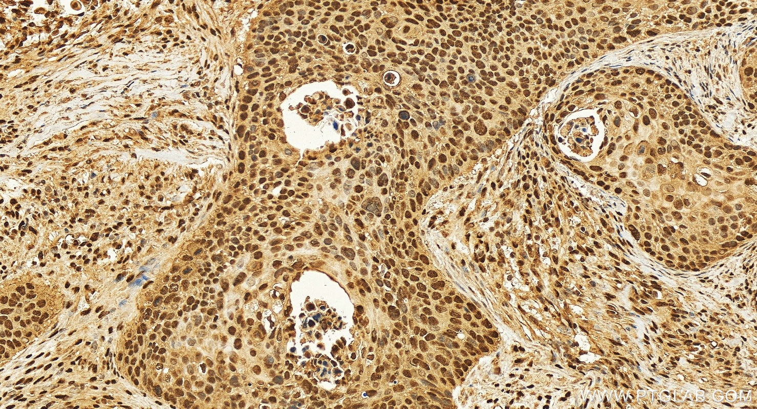 Immunohistochemistry (IHC) staining of human cervical cancer tissue using SNRPB Polyclonal antibody (16807-1-AP)