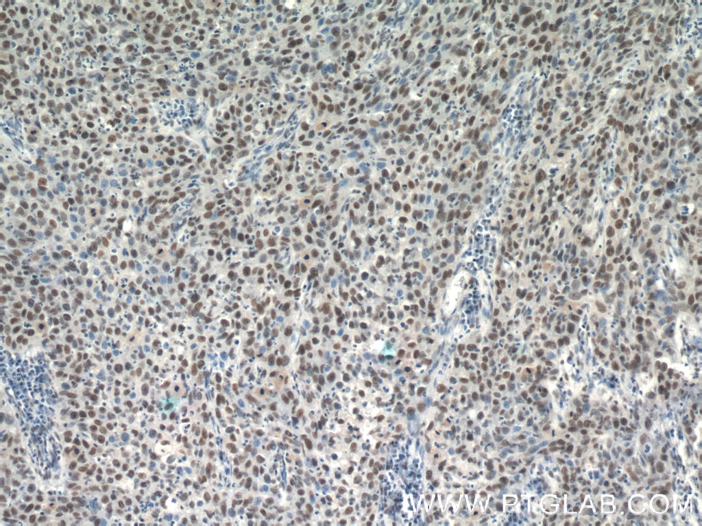 Immunohistochemistry (IHC) staining of human cervical cancer tissue using SNRPB Polyclonal antibody (16807-1-AP)