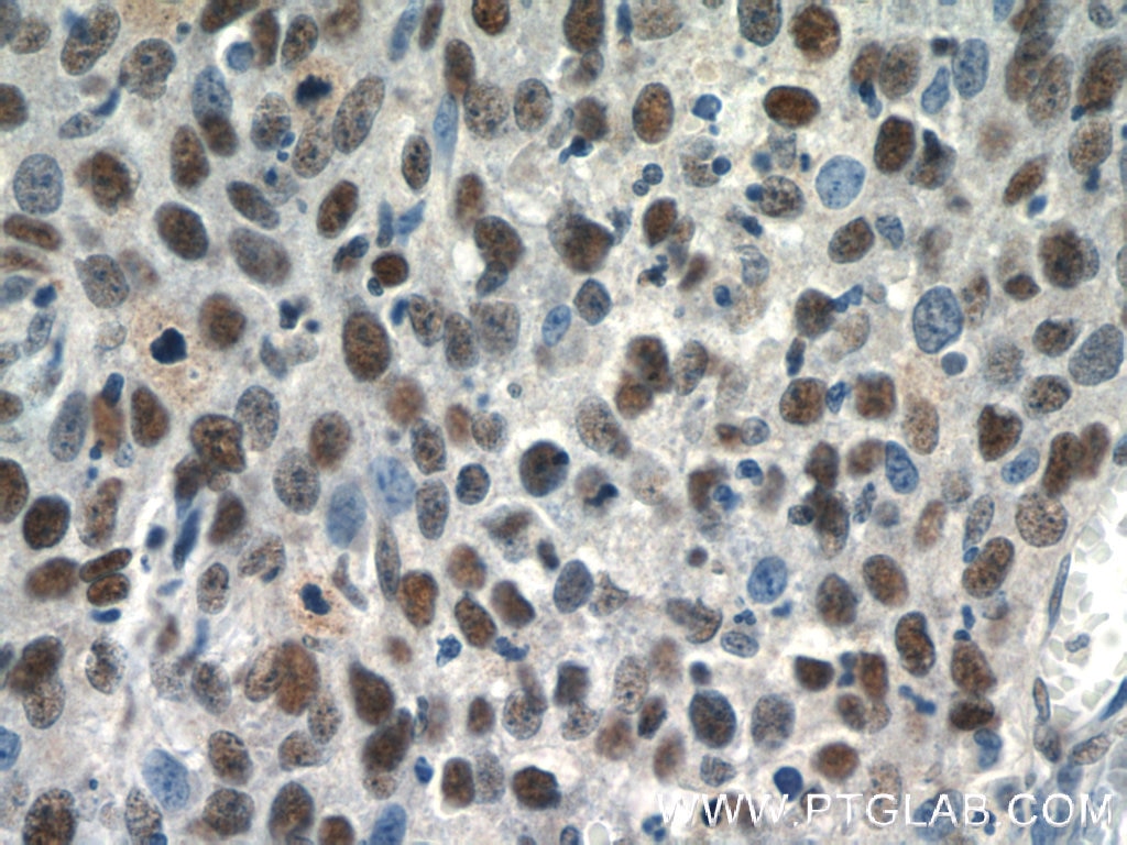 Immunohistochemistry (IHC) staining of human cervical cancer tissue using SNRPB Polyclonal antibody (16807-1-AP)