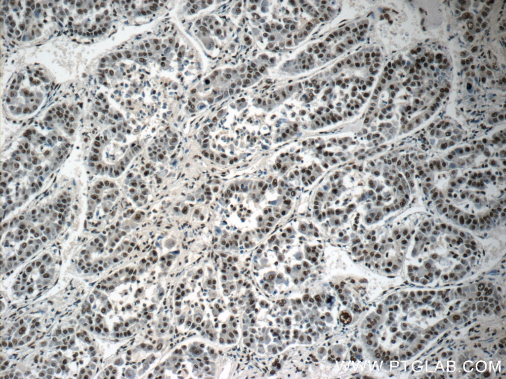 Immunohistochemistry (IHC) staining of human liver cancer tissue using SNRPB Polyclonal antibody (16807-1-AP)