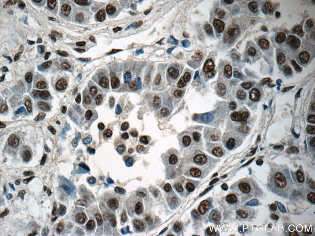 Immunohistochemistry (IHC) staining of human liver cancer tissue using SNRPB Polyclonal antibody (16807-1-AP)