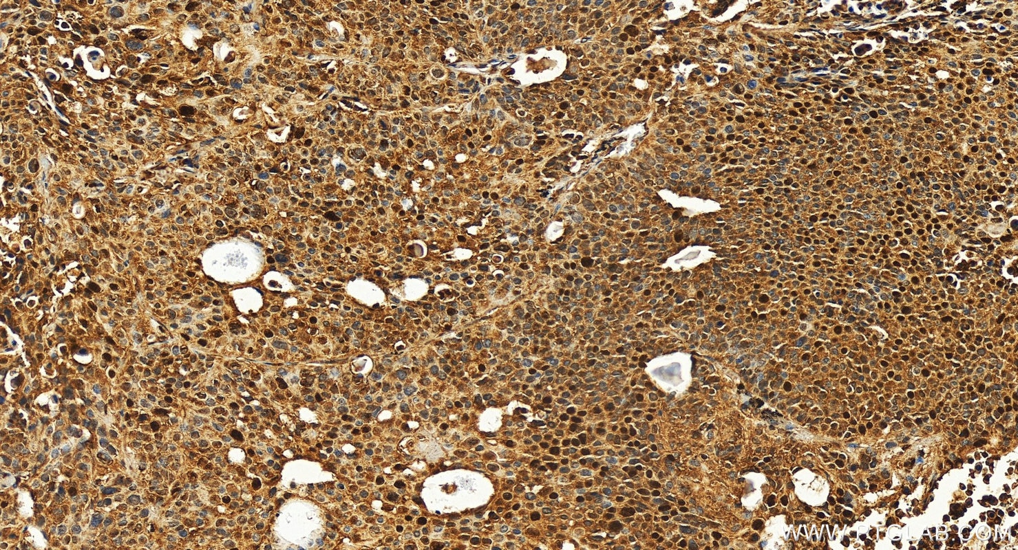 Immunohistochemistry (IHC) staining of human lung cancer tissue using SNRPB Polyclonal antibody (16807-1-AP)