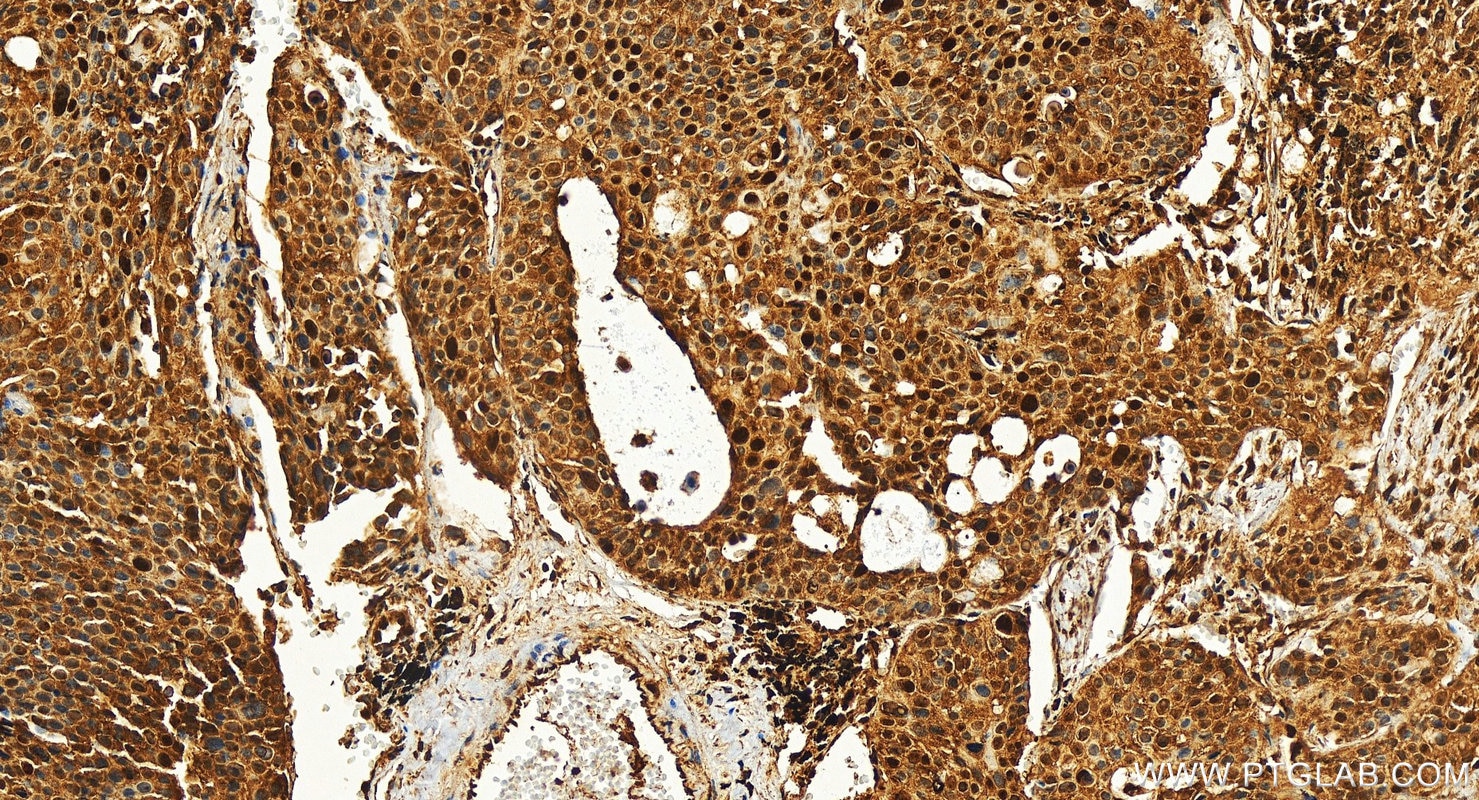 Immunohistochemistry (IHC) staining of human lung cancer tissue using SNRPB Polyclonal antibody (16807-1-AP)