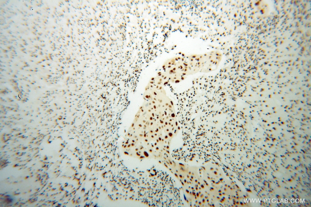 Immunohistochemistry (IHC) staining of human cervical cancer tissue using SNRPB2 Polyclonal antibody (13512-1-AP)