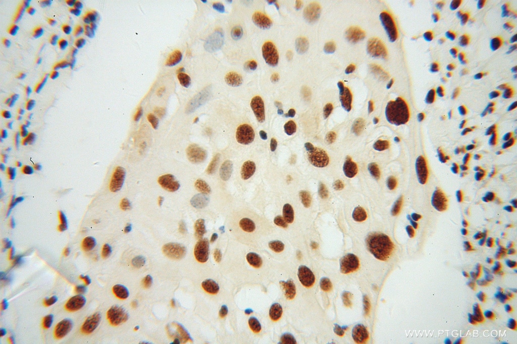 Immunohistochemistry (IHC) staining of human cervical cancer tissue using SNRPB2 Polyclonal antibody (13512-1-AP)