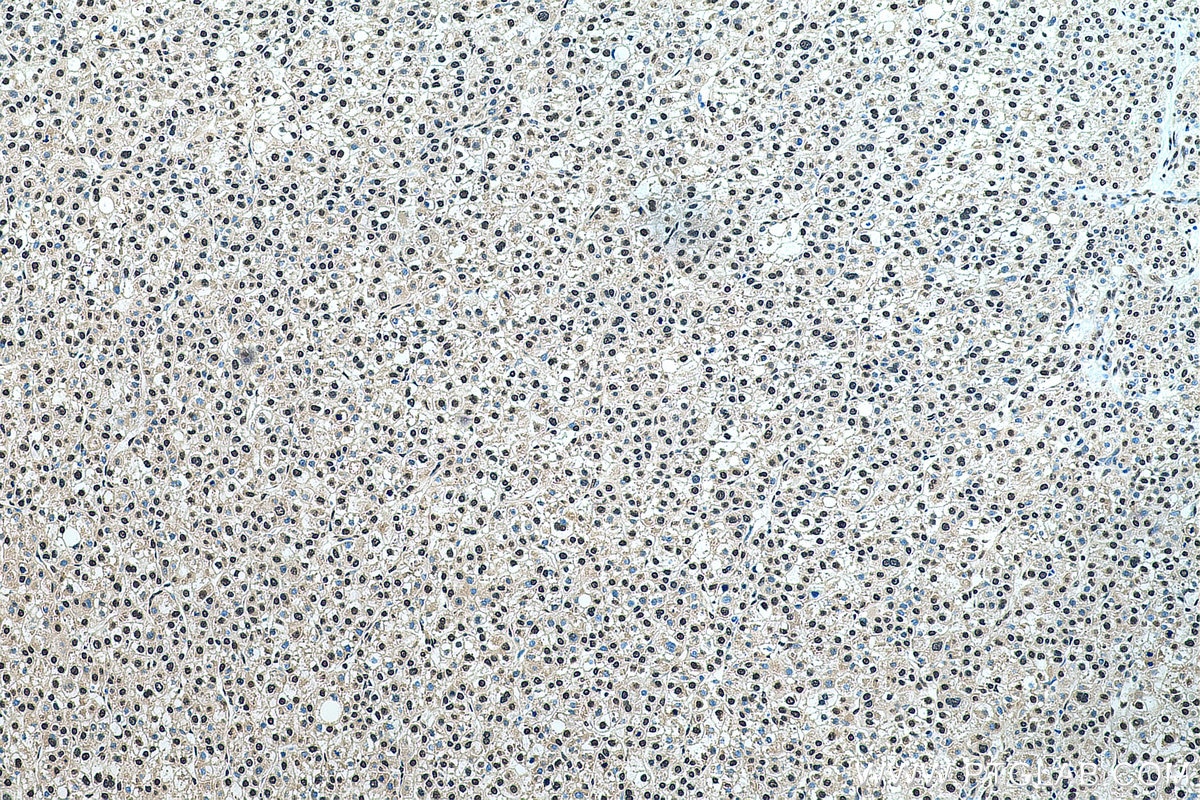 IHC staining of human liver cancer using 22428-1-AP