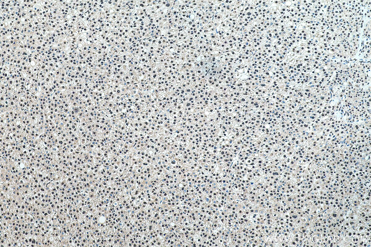 Immunohistochemistry (IHC) staining of human liver cancer tissue using SNRPC Polyclonal antibody (22428-1-AP)