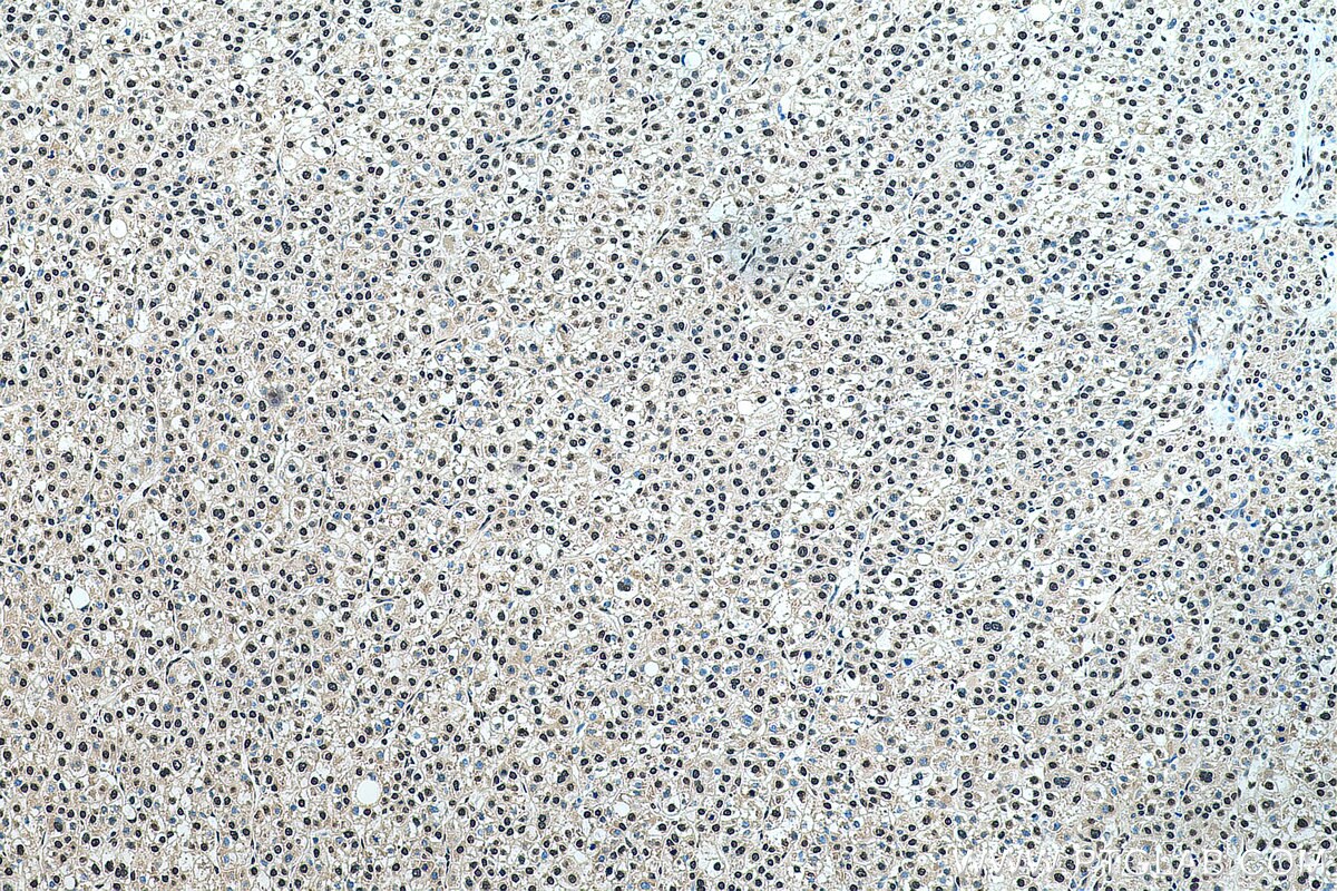 Immunohistochemistry (IHC) staining of human liver cancer tissue using SNRPC Polyclonal antibody (22428-1-AP)