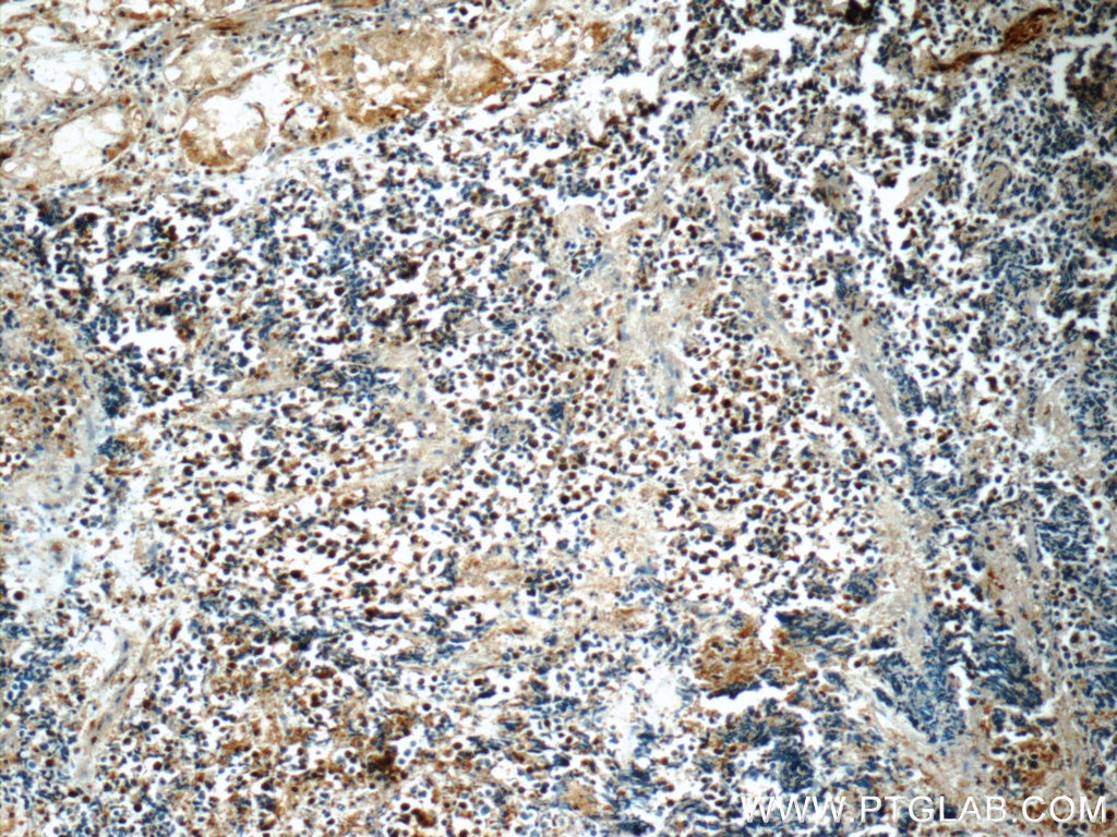 Immunohistochemistry (IHC) staining of human lung cancer tissue using SNRPD2 Polyclonal antibody (14789-1-AP)