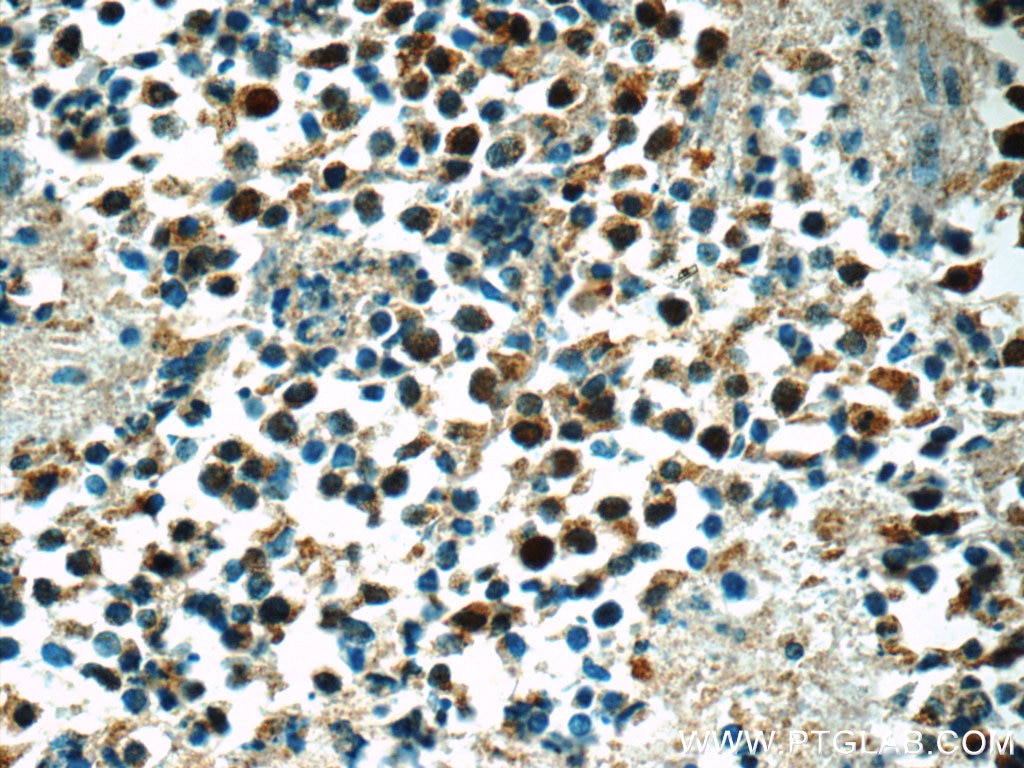 Immunohistochemistry (IHC) staining of human lung cancer tissue using SNRPD2 Polyclonal antibody (14789-1-AP)