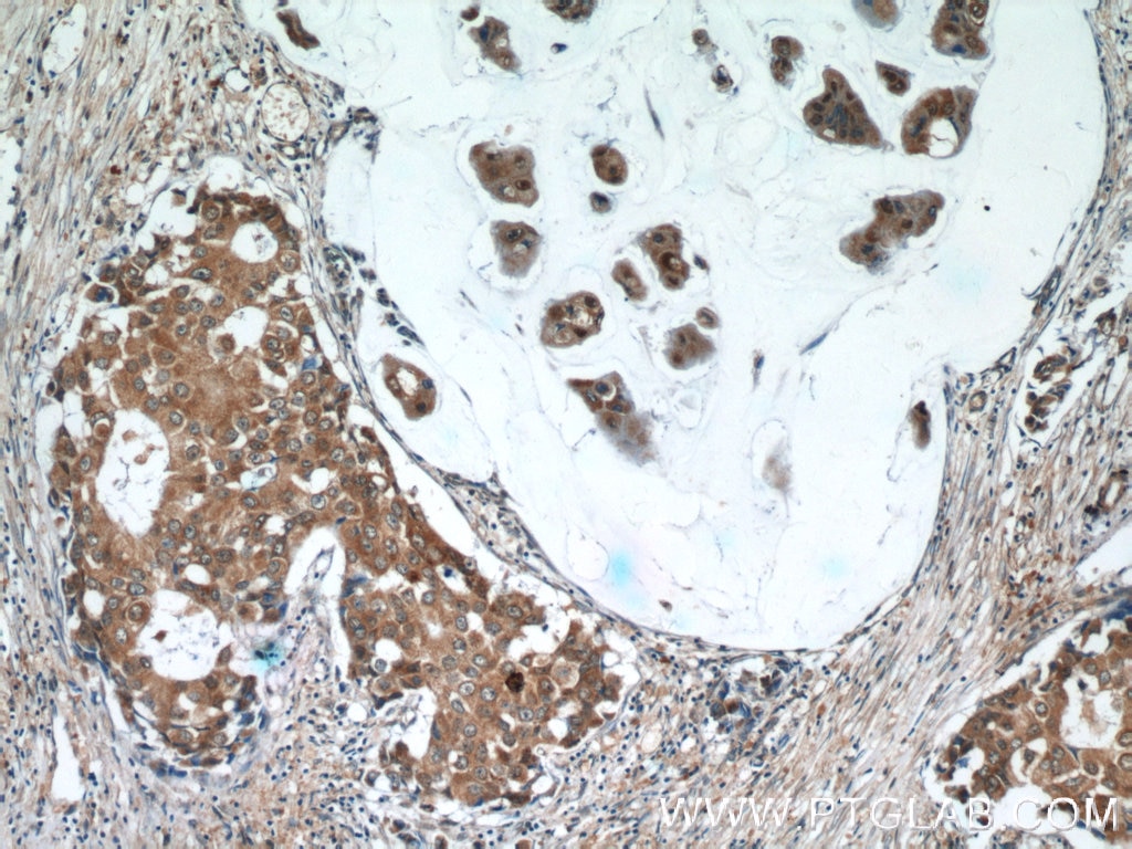 Immunohistochemistry (IHC) staining of human breast cancer tissue using SNRPD3 Polyclonal antibody (10379-1-AP)