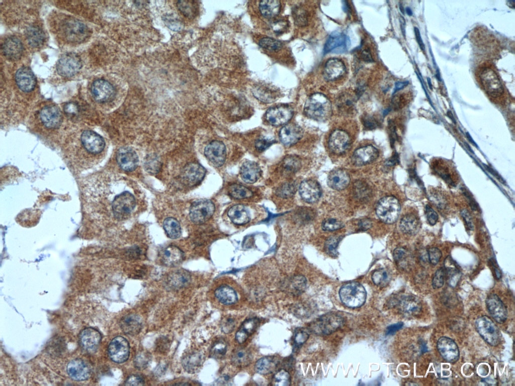 Immunohistochemistry (IHC) staining of human breast cancer tissue using SNRPD3 Polyclonal antibody (10379-1-AP)